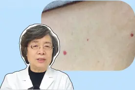 身上长凸起小红点，是代表肝脏不好或身体有问题？#医学科普 #皮肤 #健康 #涨知识 #樱桃状血管瘤视频封面