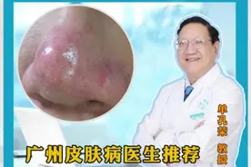 丘疹红斑酒渣鼻怎么办？ #硬核健康科普行动 试试甲硝唑凝胶也许效果不一样，可以帮助改善皮肤问题 #广东白癜风医生推荐 #单孔荣医生 #挂单孔荣号#酒糟鼻视频封面