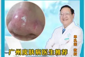 丘疹红斑酒渣鼻怎么办？ #硬核健康科普行动 试试甲硝唑凝胶也许效果不一样，可以帮助改善皮肤问题 #广东白癜风医生推荐 #单孔荣医生 #挂单孔荣号#酒糟鼻视频封面