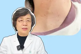 皮肤科医生教你#脖子 上的小肉粒怎么去除，别乱处理，小心越长越多！#丝状疣 #涨知识 #硬核健康科普行动 #丝状疣涂抹什么药膏视频封面