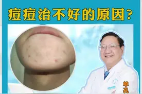 你的痤疮反反复复痘痘治不好的原因 #硬核健康科普行动 #医疗小常识 #皮肤问题 #广东皮肤病医生推荐 #单孔荣医生视频封面