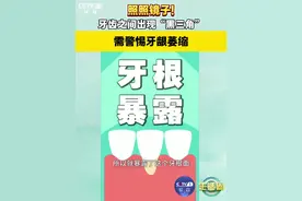 【照照镜子！#牙缝出现黑三角警惕牙龈萎缩 】照镜子时，若发现牙齿之间出现“黑三角”，这可能是因为牙龈炎症导致牙龈萎缩，牙齿缝隙变大。“黑三角”不仅会让食物嵌塞，还影响美观与发音，千万别忽视，要尽快就医！视频封面