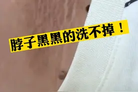 脖子黑一块，怎么搓都不干净！这是#黑棘皮病 ，想改善需要记住一个关键！#医学科普 #肥胖视频封面