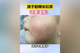 别把痱子当湿疹！10岁左右孩子脸颊长红疹，家长可以这样处理#痱子 #湿疹 #医学科普  #新手爸妈 #健康