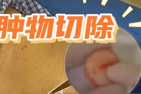 臀部大囊肿切除！ #整形外科 #医学科普 #手术 #挤痘大师