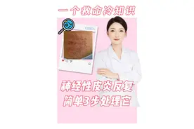 神经性皮炎反复，简单3步处理它 #医学科普 #神经性皮炎 #知识点亮她视频封面