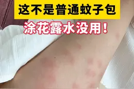 身上这种硬硬痒痒的包，可不是普通的蚊子包！#医学科普 #虫咬皮炎 #蚊子包 #痒 #蚊虫叮咬视频封面