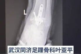 距骨坏死的太厉害了,只能做融合手术保不了了 #距骨 #距骨坏死 #硬核健康科普行动视频封面