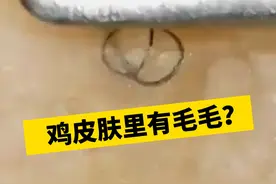 皮肤摸起来疙疙瘩瘩，医生教你这样处理#鸡皮肤 #毛周角化症 #皮肤问题 #疙瘩 #夏天视频封面