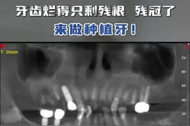 牙齿烂得只剩残根残冠了，来做种植牙！ #种植牙 #种牙 #抖出健康知识宝藏