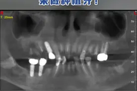 牙齿烂得只剩残根残冠了，来做种植牙！ #种植牙 #种牙 #抖出健康知识宝藏视频封面