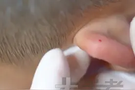 11月18日，河南郑州。忧思过度总做梦？反反复复爱长痘？中医分享窍门：耳尖放血，“耳尖有了，针也有了，勇气去哪找？”#常识中国视频封面