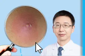 火疖子又肿又痛千万别挤，教你如何处理。#医学科普 #火疖子 #硬核健康科普行动视频封面