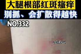 #皮肤健康大腿根部红斑剧烈瘙痒，一抓容易形成一大片，还容易留下黑印子，可以这样处理。#股癣 #医学知识科普 