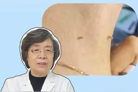 脖子或腋下长这种小肉丁，小心是HPV病毒感染！#医学科普 #皮肤 #健康 #丝状疣 #HPV视频封面