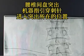 #腰椎间盘突出 #介入穿刺 #腰腿痛 #麻醉 #硬核健康科普行动视频封面