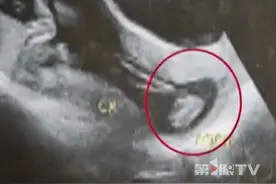 女子怀孕21周时胎儿小脚丫掉了出来，保胎药物不适用，随时可能流产。经救治，25+1周时宝宝顺利降生，体重仅750克，属于“超早产儿”。#女子怀孕21周时胎儿小脚丫掉了出来 #怀孕 #早产儿