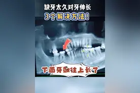 缺牙太久对牙伸长，3个解决方案！ #种植牙 #种牙  #抖出健康知识宝藏
