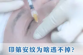 印第安纹填充要领 #印第安纹剥离术 #印第安纹怎么办 #印第安纹 #印第安纹怎么改善视频封面