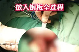 #骨折 #手术室 #手术视频封面