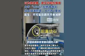 以为很健康，其实可能伤身体！女子“16+8”轻断食两年，结石填满胆囊，大的有2厘米。（原创采访）视频封面