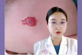 宝宝身上莫名长“草莓样的红斑凸起”，当心是#婴儿血管瘤 ，教你1个消退方法 #医学科普 #育儿经验分享 #新生儿 #宝妈视频封面