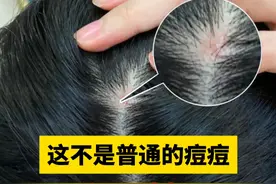 头皮上长红疙瘩，一碰就疼，医生教你2步正确处理#人表皮生长因子凝胶 #医学科普 #皮肤 #头皮毛囊炎 #健康视频封面