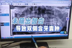 引起双侧患含牙囊肿，是什么原因#口腔科普 #医学科普 #医学影像 #诊室日常视频封面