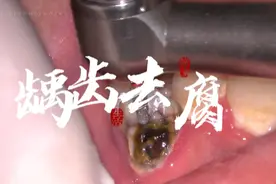 把虫牙去除干净的时候特别的解压
只有去除彻底
补牙后才牢固视频封面