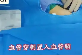 介入科日常基操股动脉穿刺 介入科日常基操股动脉穿刺#硬核健康科普行动  #医疗创作者培优计划 #介入手术