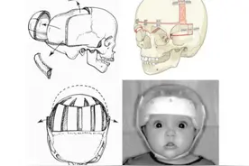 头型这个样子，可能就要去医院了，需要排除颅缝早闭的情况。#颅缝早闭 #舟状头 #方颅 #医学科普 #父母必看系列