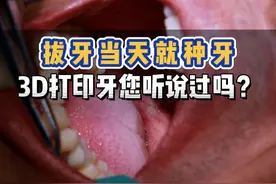 拔牙当天就种牙，3D打印牙您听说过吗？#种植牙 #3d打印视频封面