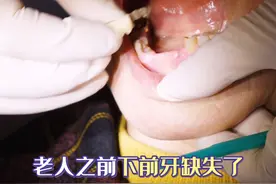 老人的活动假牙掉了，这样补救！ #活动假牙 #种植牙 #种牙视频封面