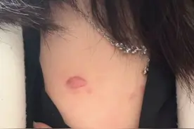 瘦高的人才会有“气胸”?26岁微胖女生患“气胸”“发病时无法喘气，最后切了一块肺！”#万万没想到 #社会百态 #健康 #科普视频封面