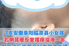 这位安徽临泉的患者，3年前找我做的左侧耳瘘恢复良好，右侧瘙痒溢液一年，找到我寻求我的治疗#医学科普 #耳前瘘管 #硬核健康科普行动  #武汉陈金辉视频封面