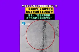 4月28日（采访），河南郑州，51岁男子从20多岁开始抽烟，每天一包，一周前突然肚子疼紧急就医，检查后发现肚子里全是血栓，医生：“患者属于肠梗，治疗不及时可能危及生命”。