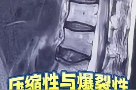 脊柱骨折类型的鉴别：是压缩性还是爆裂性？ #医学影像 #医学生视频封面