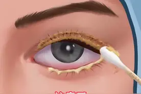 眼睛痒 看不清，一直揉眼还揉出了“结膜炎”#眼科科#爱护眼睛睛#医学科普普#结膜炎炎#爱眼护眼预防近视视频封面