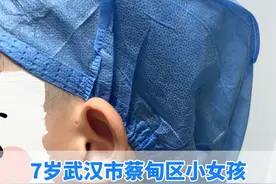 这是耳瘘做手术最好的状态#医学科普 #耳前瘘管 #硬核健康科普行动  #听医生一句劝视频封面