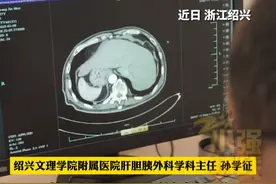 67岁大叔就医看胆结石发现竟是“镜面人”，医生：心、肝、胆、脾都长反了，发生率约为百万分之一。近日 浙江绍兴 #浙江dou知道 @抖音短视频视频封面