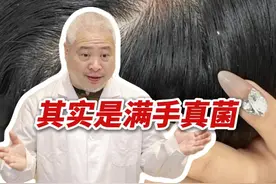 你别再抠#头屑 了！抠出一手白泥不说，小心还会#脱发 ！#脂溢性皮炎 #痒 #抖出健康知识宝藏视频封面