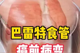 巴雷特食管属于食管癌的癌前病变，是胃食管反流病的并发症之一。#医学科普 #医生日常 #胃食管反流 #硬核健康科普行动视频封面