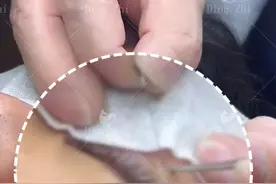 全切双眼皮拆线!竟然是这样的! 拆完线之后秒变小梁朝伟!#全切双眼皮 #双眼皮 #丁志双眼皮 #丁志 #双眼皮拆线视频封面