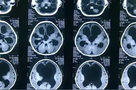小朋友颅脑发现#蛛网膜囊肿 要紧吗？怎么处理？#关爱儿童健康 #健康科普 #医学科普 #育儿 视频封面