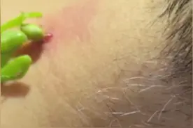 用螳螂治疗#丝状疣 ，这种偏方真的靠谱吗？#硬核健康科普行动  #涨知识 #入冬换季不患疾 #脖子上长小肉粒