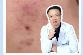 刷酸能不能改善毛孔粗大呢？#皮肤科医生谢红付 #刷酸 #毛孔粗大