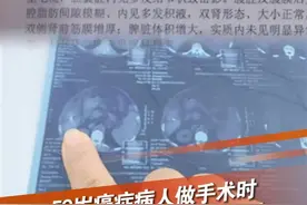 安徽亳州，59岁男子患有肝癌，在医院做肝脏手术时，一个长约15毫米的针头落在了体内。2月11日，亳州市中医院工作人员表示，经专家会诊，体内的针头的位置比较固定，建议不取。亳州市卫健委工作人员表示，因赔偿金额存在分歧，此事还在协商中。#安徽亳州 #医疗事故 #手术 @抖音短视频 @DOU+小助手视频封面