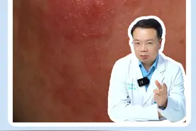 刷酸能改善皮炎发红吗？#皮肤科医生谢红付 #皮炎湿疹 #发红发烫视频封面