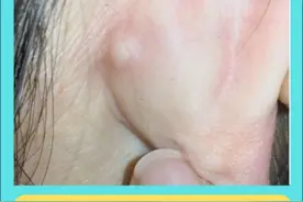 耳朵后面长硬硬的包，徐医生教你解决 耳朵后面长硬硬的包，不要硬挤，徐医生教你解决 #医学科普 #火疖子 #皮脂腺囊肿 #硬核健康科普行动视频封面