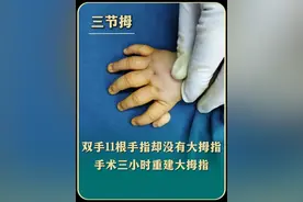 双手11根手指却没有大拇指 手术三小时重建大拇指，术后外观和功能都恢复的不错#三节拇指 #多指 #医者仁心 #专业的事交给专业的人 #医学科普视频封面